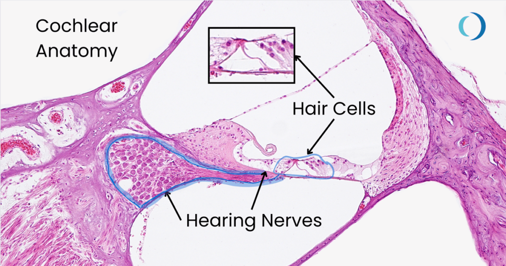 damage to inner ear hair cells causes tinnitus